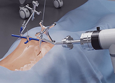 骨科手术机器人收费标准:导航功能2000元封顶