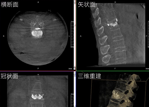三维C形臂与二维C形臂临床图像实时对比