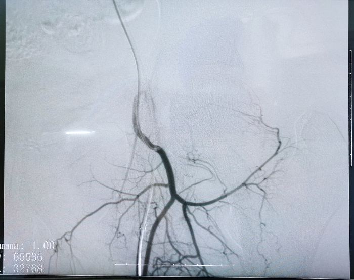米兰网页版登录入口平板介入中C在FTE手术过程中拍摄的造影图像